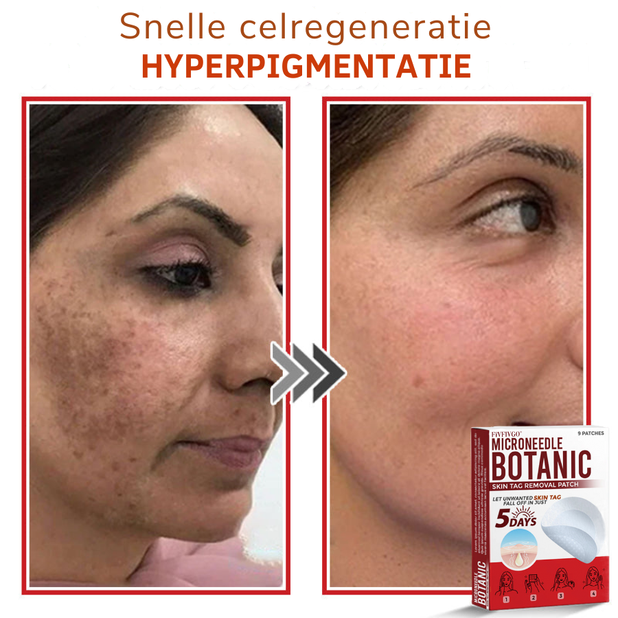 Vordela® MicroNeedle Botanic Skin Tag Removal Patch