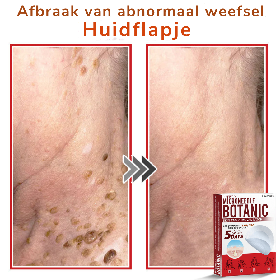 Vordela® MicroNeedle Botanic Skin Tag Removal Patch